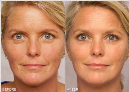 Retinol Gel 0.1 - 20 gm