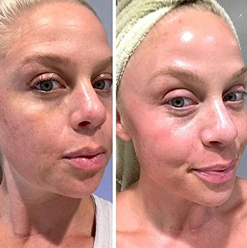 Retinol Gel 0.1 - 20 gm