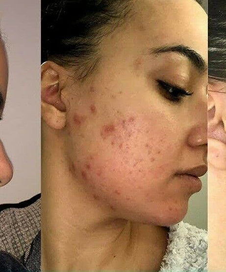 Retinol Gel 0.1 - 20 gm