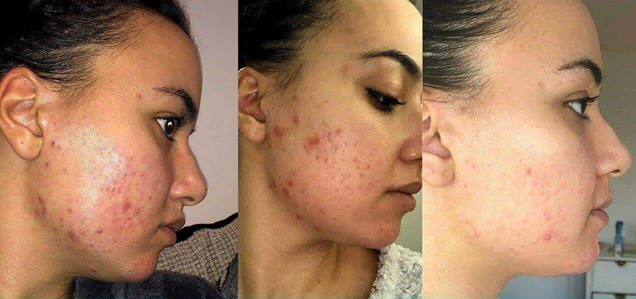 Retinol Gel 0.1 - 20 gm