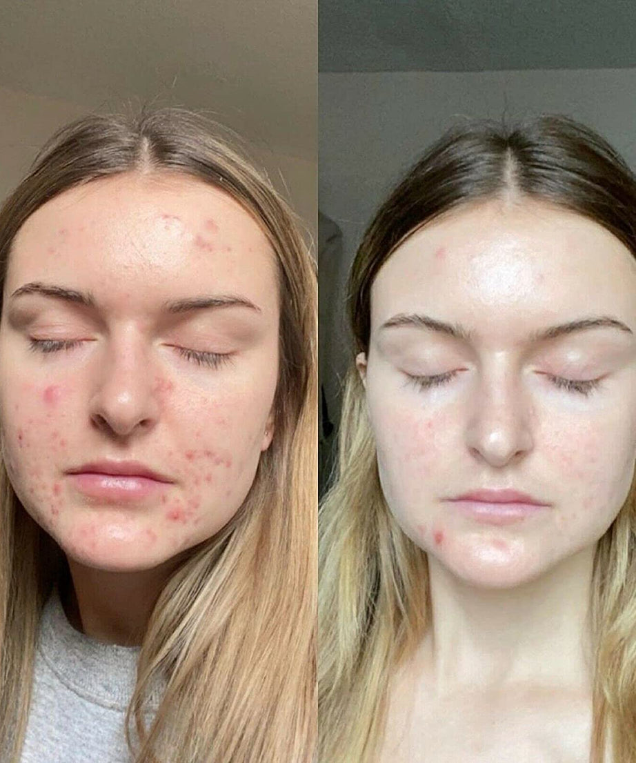 Retinol Gel 0.1 - 20 gm